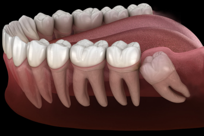 Wisdom Teeth